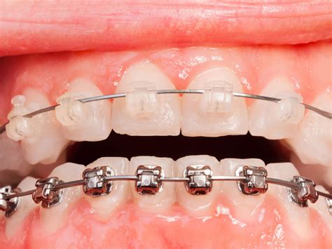 Metal Braces vs. Ceramic Braces: How They Actually 